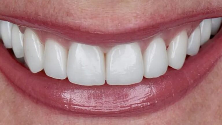 The Beauty of Zirconia Crowns: A Modern Solution for a Confident Smile