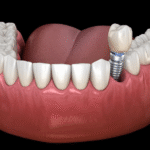 How Dental Implants Transform Smiles and Confidence 