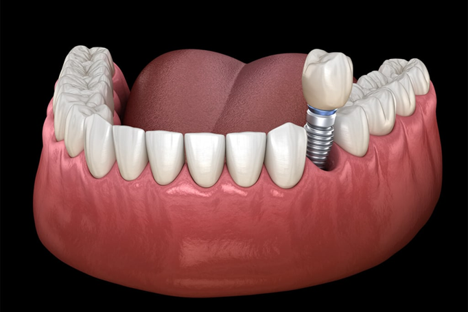 How Dental Implants Transform Smiles and Confidence 
