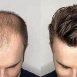 How Toupee Hairpieces Are Helping Men Regain Confidence?