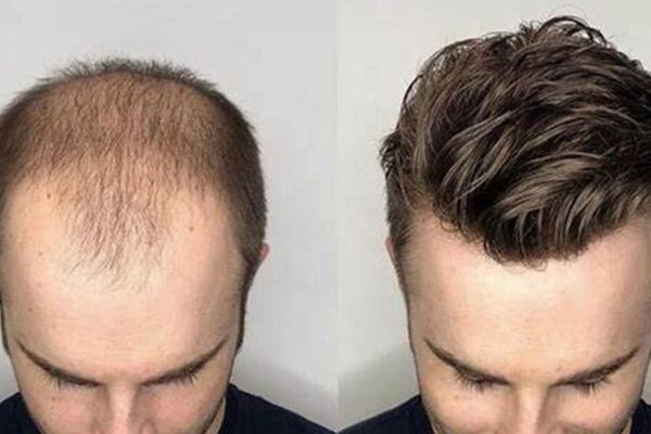 How Toupee Hairpieces Are Helping Men Regain Confidence?