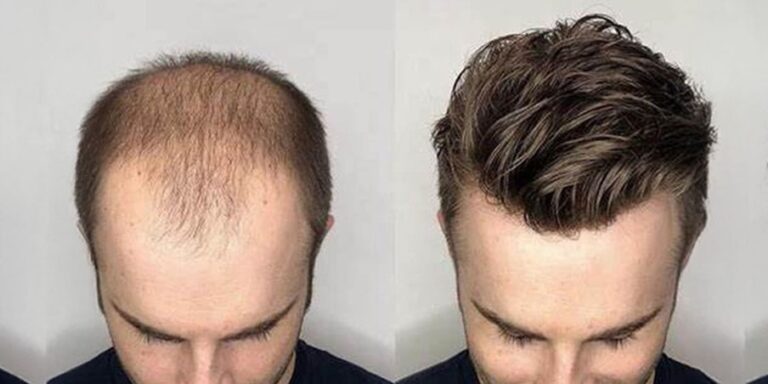 How Toupee Hairpieces Are Helping Men Regain Confidence?