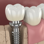 How Dental Implant Dentists Ensure Long-Lasting Tooth Restorations