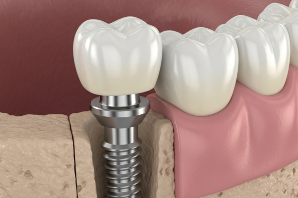 How Dental Implant Dentists Ensure Long-Lasting Tooth Restorations